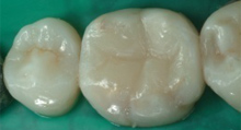 capsule-denti