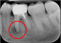 granuloma