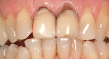 corona-denti-primadellacura