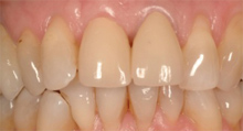 corone-denti